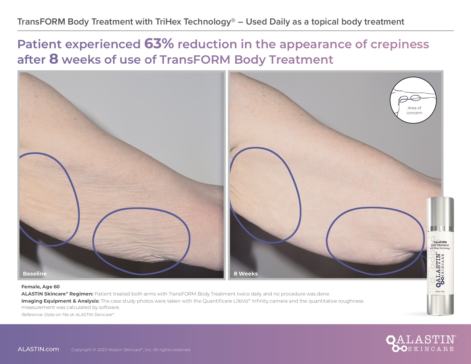 Alastin TransFORM Body Treatment with TriHex Technology - Chicago Skin Science